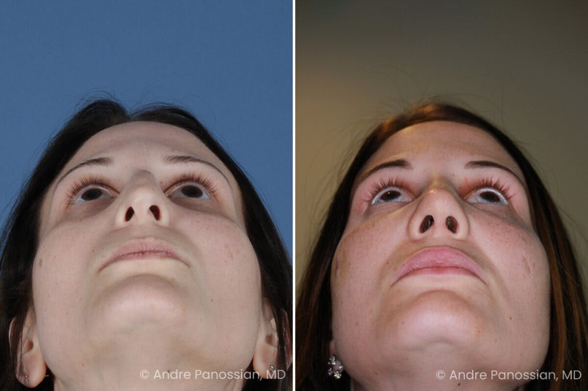 Rhinoplasty Before & After Gallery - Patient 331751 - Image 6