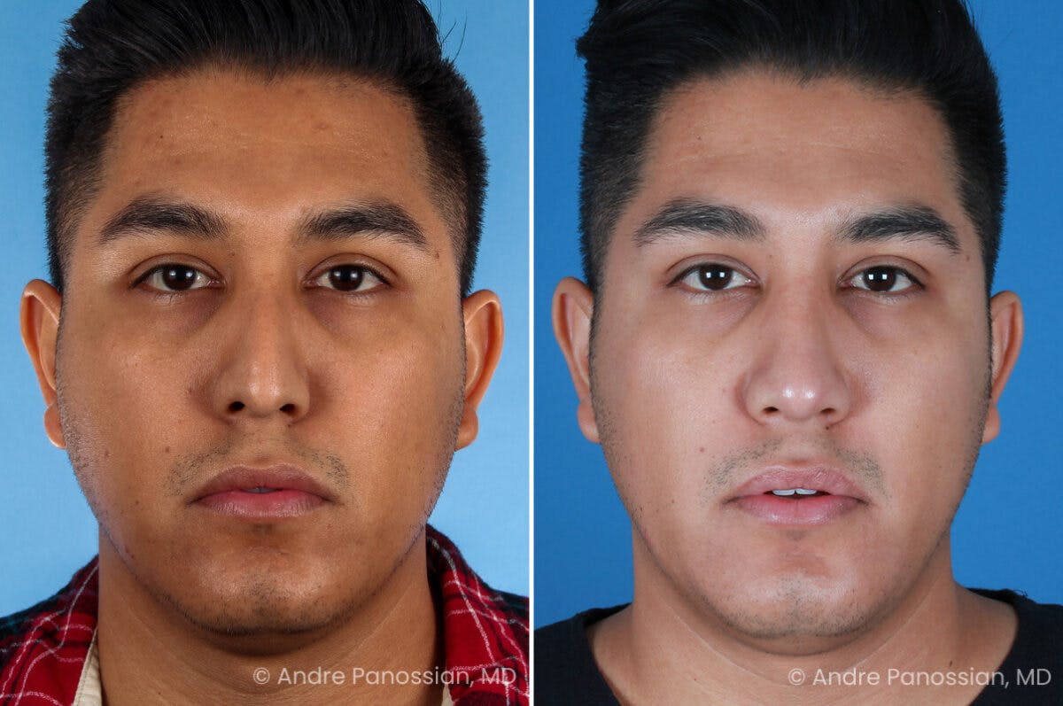 Rhinoplasty Before & After Gallery - Patient 198808 - Image 2