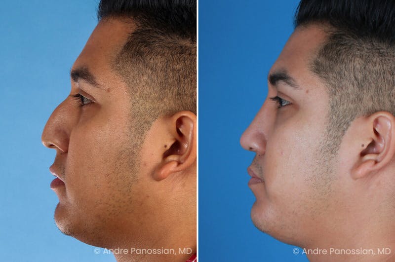 Rhinoplasty Before & After Gallery - Patient 198808 - Image 1