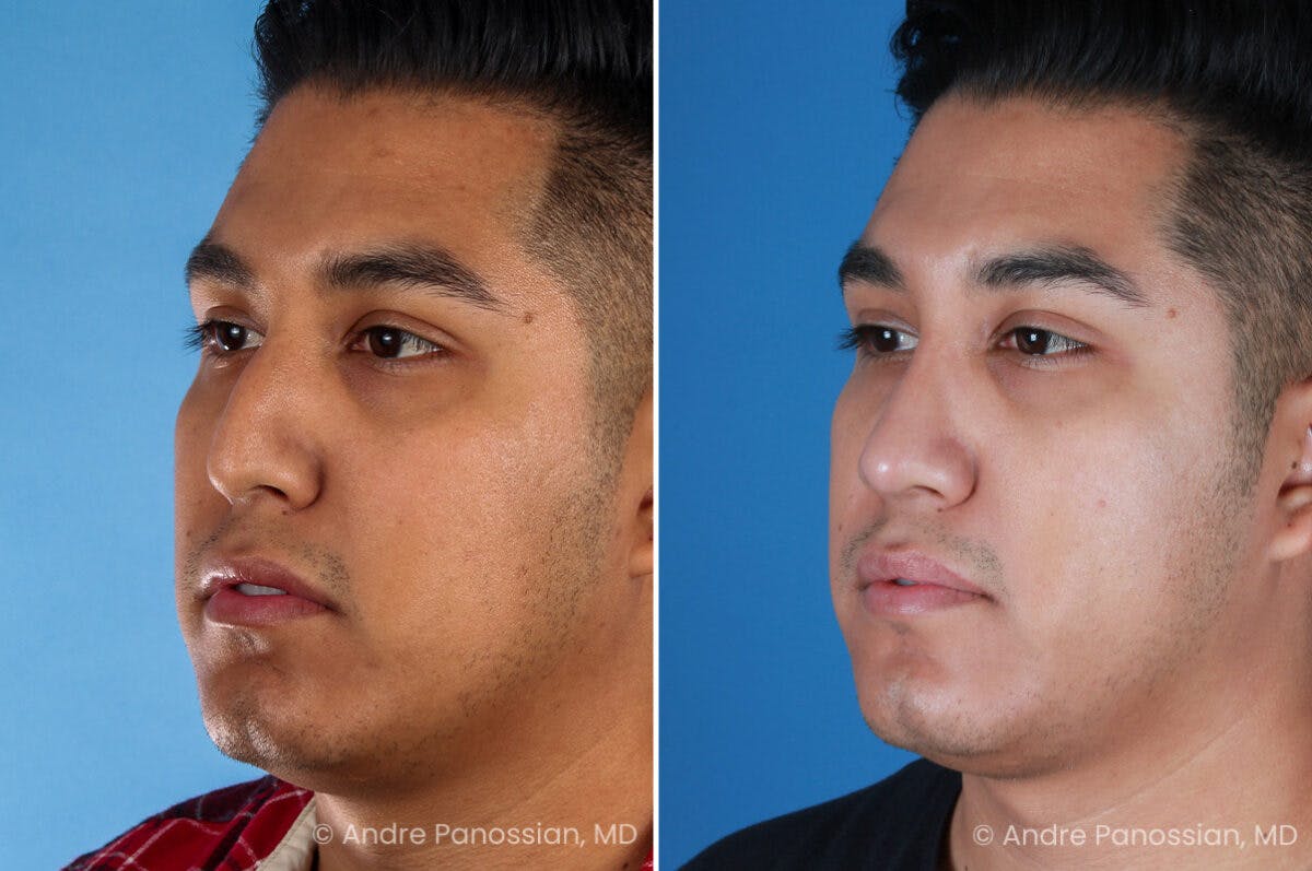 Rhinoplasty Before & After Gallery - Patient 198808 - Image 3