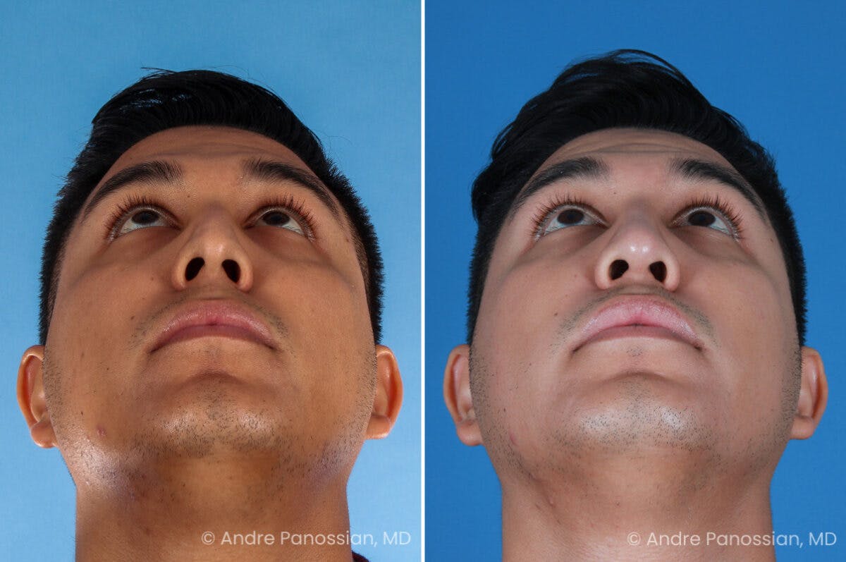 Rhinoplasty Before & After Gallery - Patient 198808 - Image 4