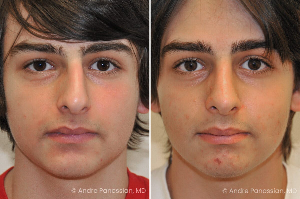 Rhinoplasty Before & After Gallery - Patient 239762 - Image 2