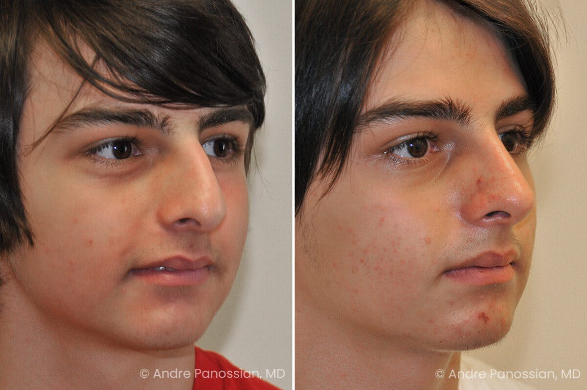 Rhinoplasty Before & After Gallery - Patient 239762 - Image 3