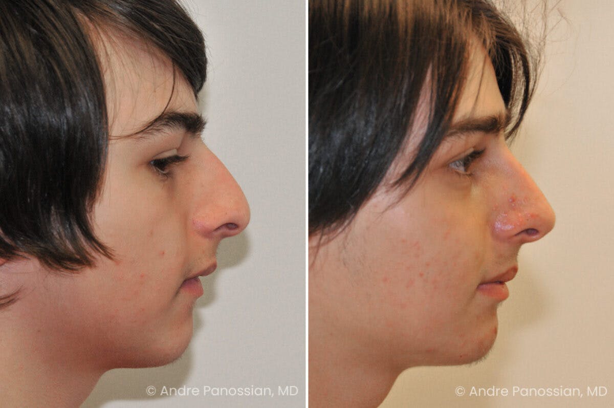 Rhinoplasty Before & After Gallery - Patient 239762 - Image 1