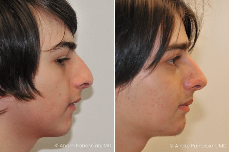 Rhinoplasty Before & After Gallery - Patient 239762 - Image 1