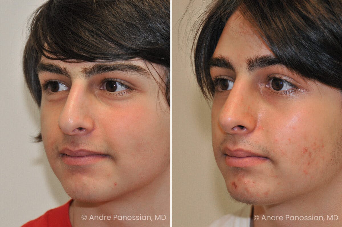 Rhinoplasty Before & After Gallery - Patient 239762 - Image 4