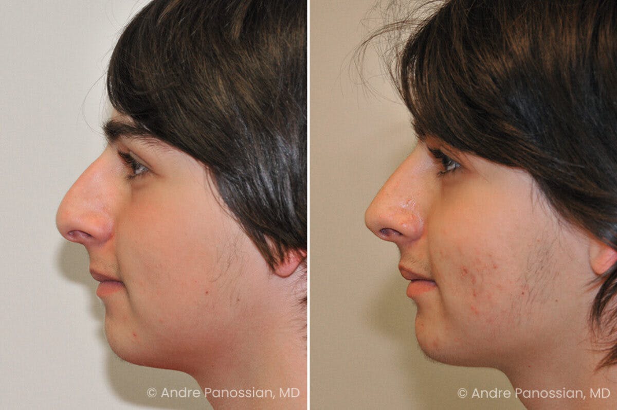 Rhinoplasty Before & After Gallery - Patient 239762 - Image 5