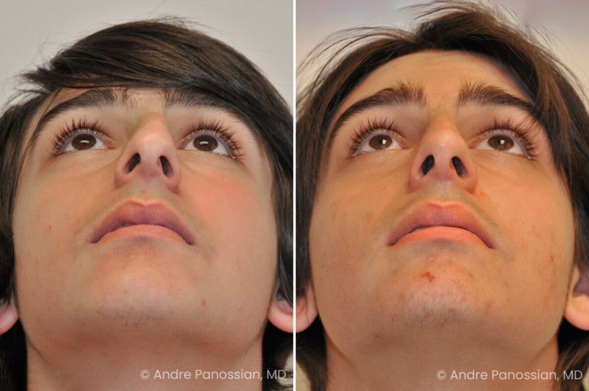 Rhinoplasty Before & After Gallery - Patient 239762 - Image 6