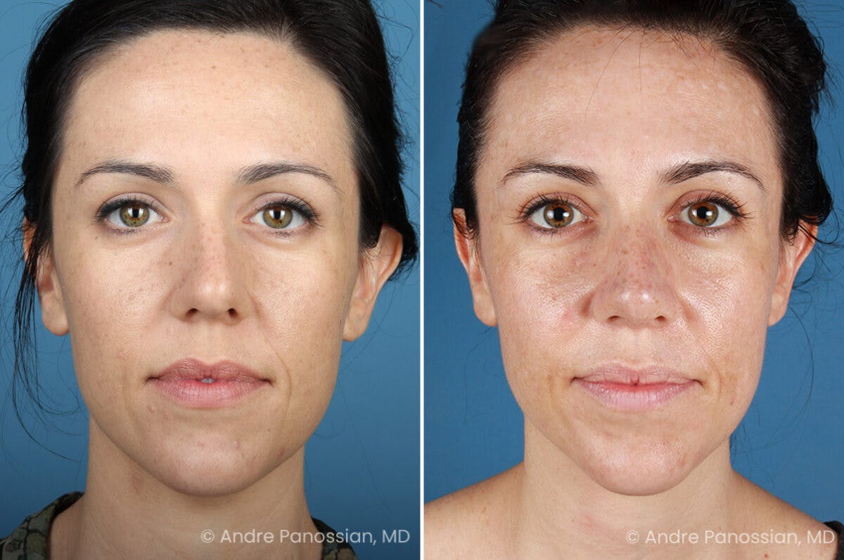 Rhinoplasty Before & After Gallery - Patient 399974 - Image 2