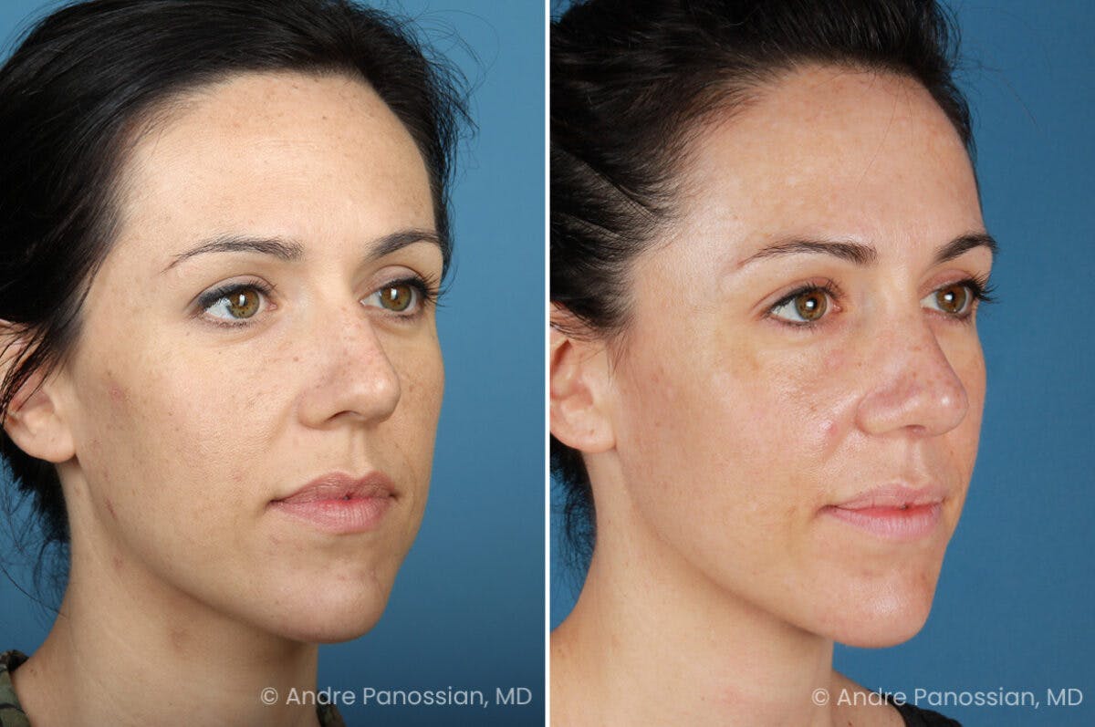 Rhinoplasty Before & After Gallery - Patient 399974 - Image 3