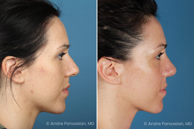 Rhinoplasty Before & After Gallery - Patient 399974 - Image 1