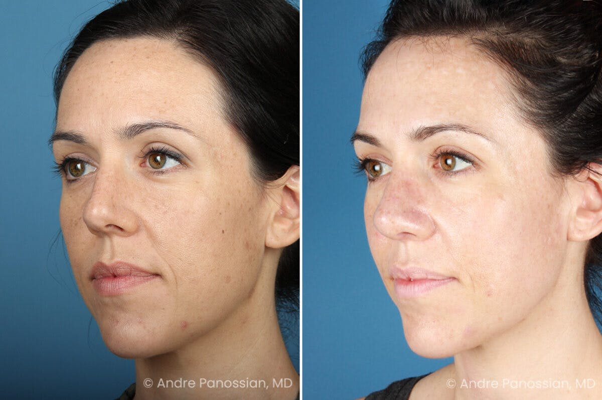 Rhinoplasty Before & After Gallery - Patient 399974 - Image 4
