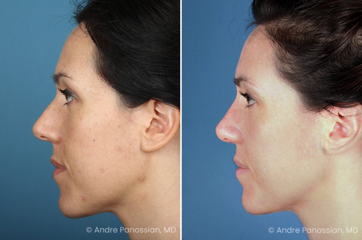 Rhinoplasty Before & After Gallery - Patient 399974 - Image 5