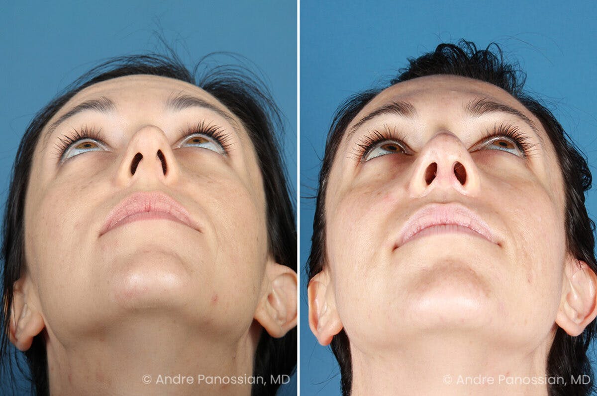Rhinoplasty Before & After Gallery - Patient 399974 - Image 6