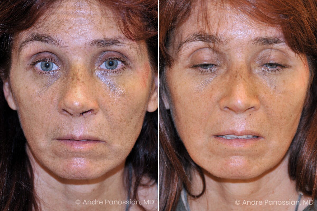 Rhinoplasty Before & After Gallery - Patient 129363 - Image 2