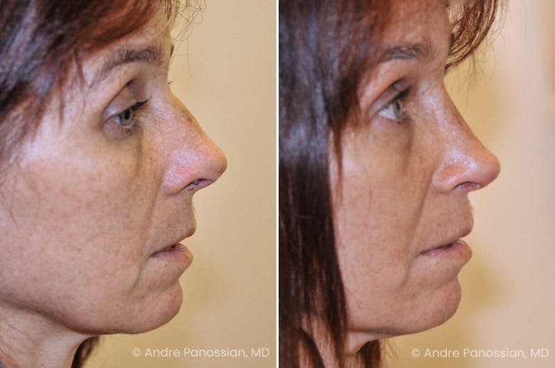 Rhinoplasty Before & After Gallery - Patient 129363 - Image 1