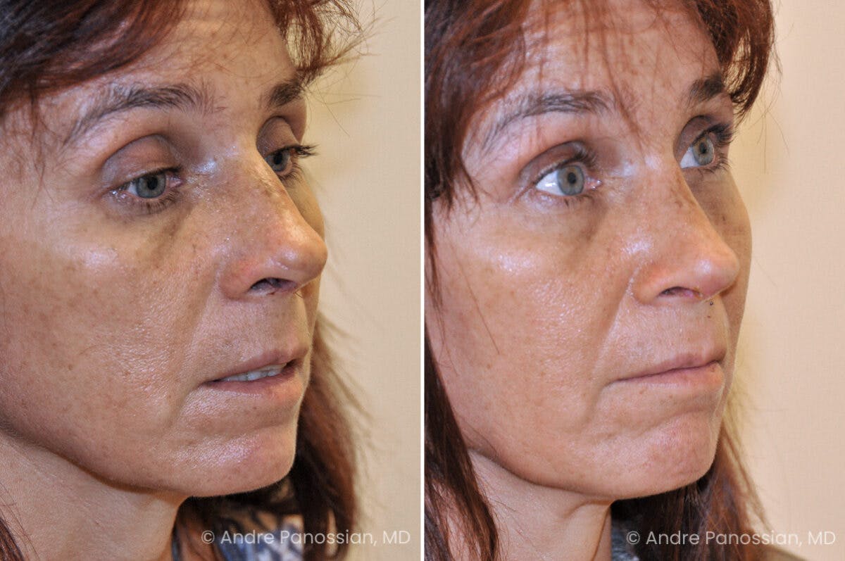 Rhinoplasty Before & After Gallery - Patient 129363 - Image 3