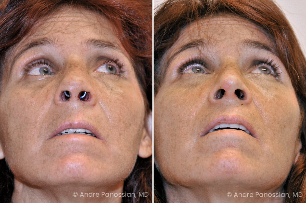 Rhinoplasty Before & After Gallery - Patient 129363 - Image 4