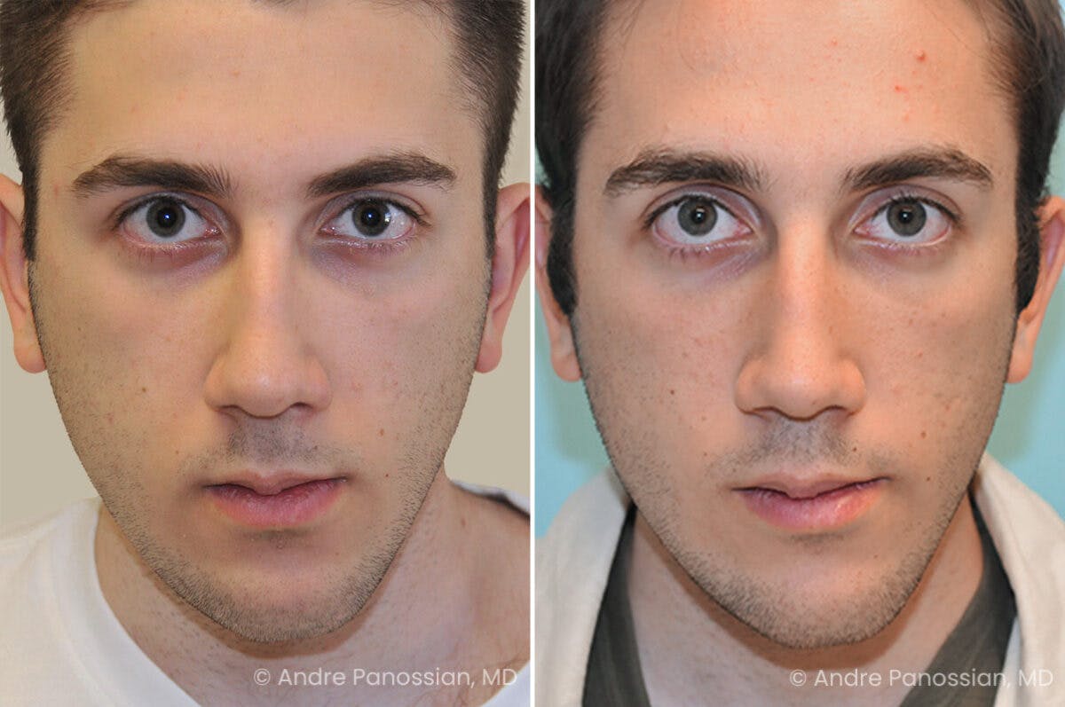 Rhinoplasty Before & After Gallery - Patient 373228 - Image 2