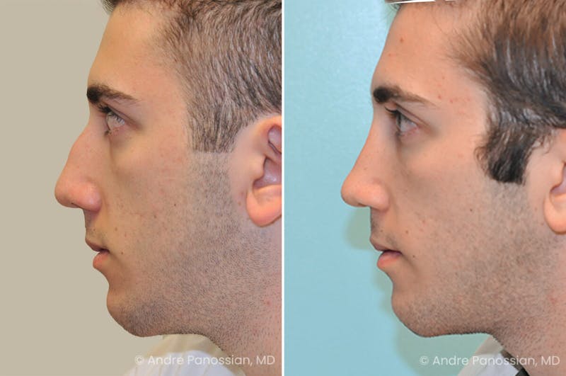 Rhinoplasty Before & After Gallery - Patient 373228 - Image 1