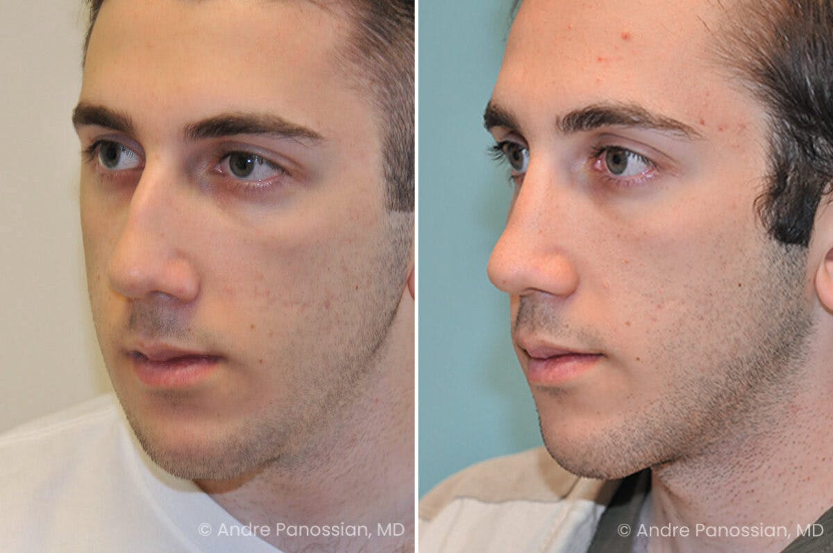 Rhinoplasty Before & After Gallery - Patient 373228 - Image 3