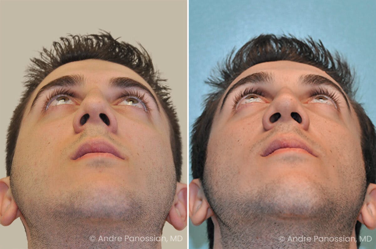 Rhinoplasty Before & After Gallery - Patient 373228 - Image 4