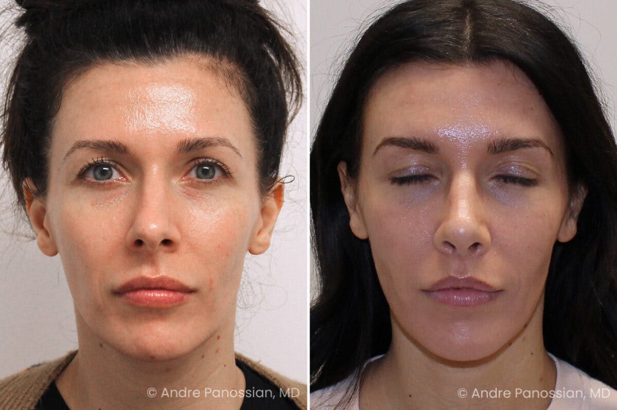 Rhinoplasty Before & After Gallery - Patient 122055 - Image 2