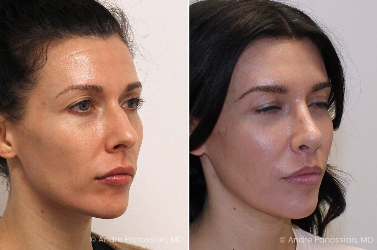Rhinoplasty Before & After Gallery - Patient 122055 - Image 3