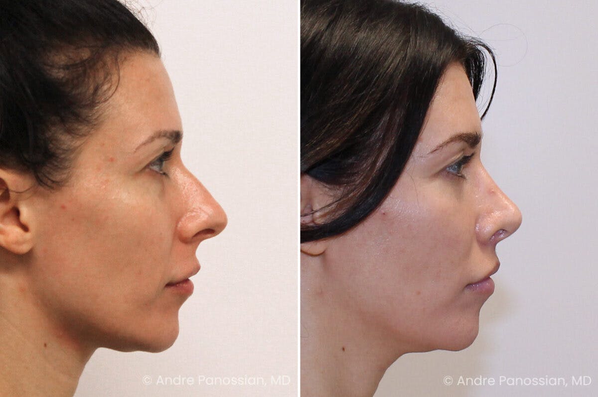 Rhinoplasty Before & After Gallery - Patient 122055 - Image 1