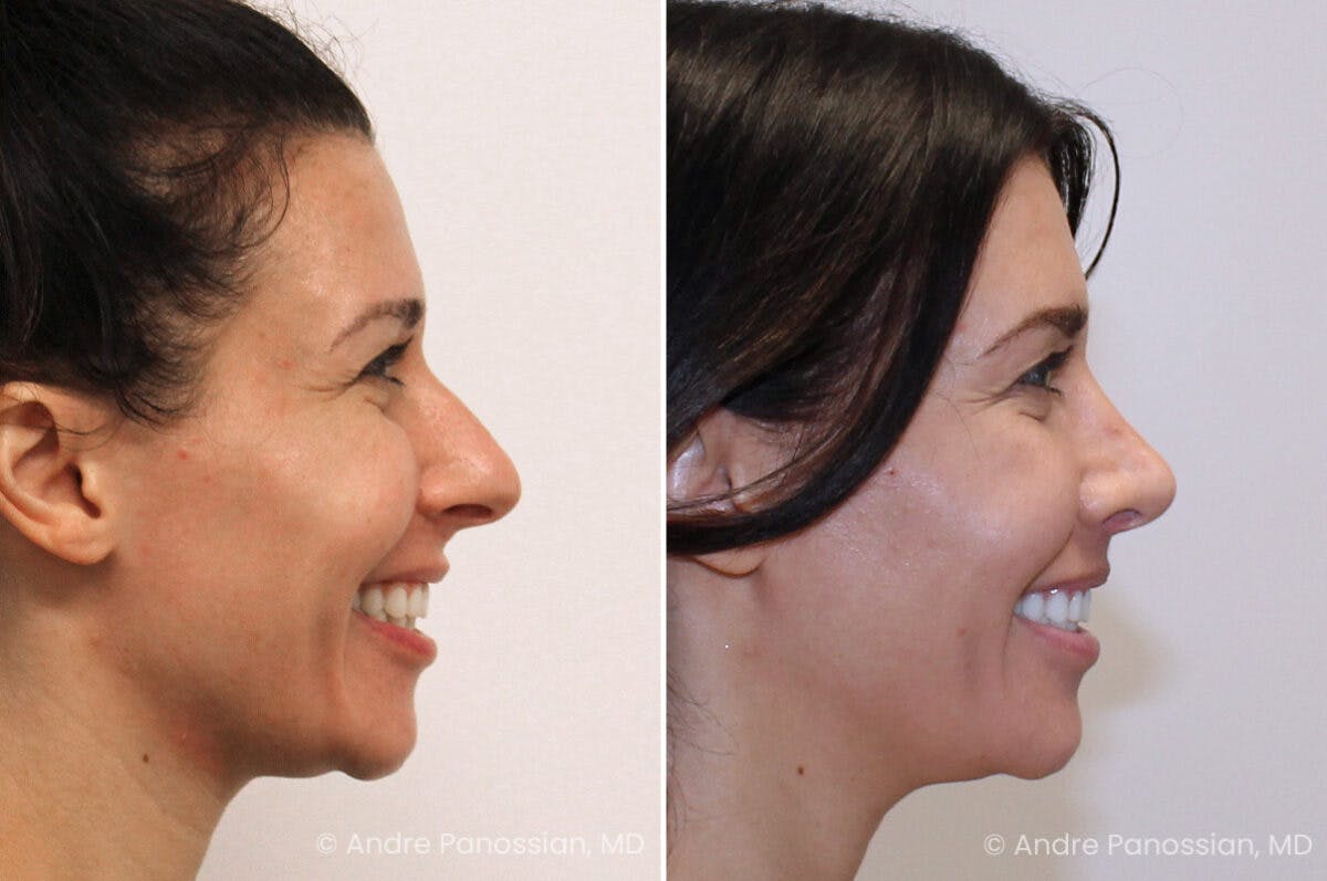 Rhinoplasty Before & After Gallery - Patient 122055 - Image 4