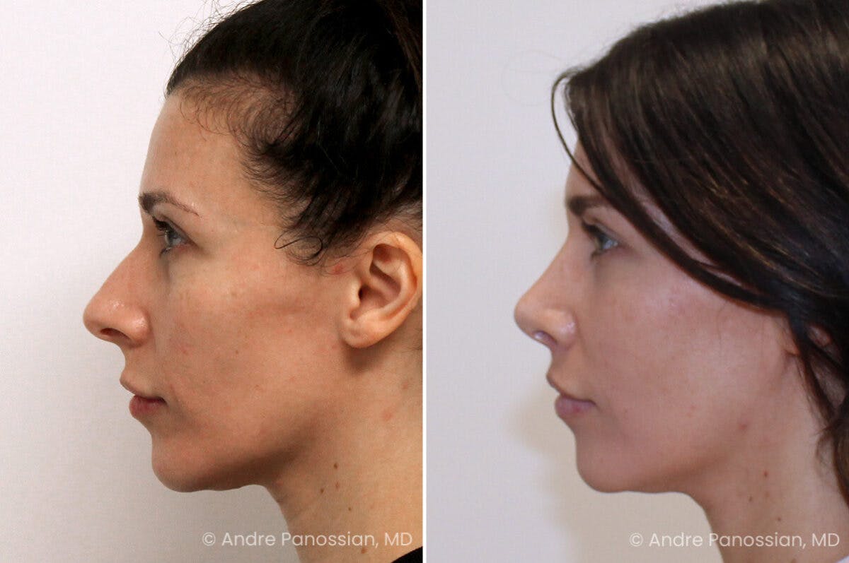 Rhinoplasty Before & After Gallery - Patient 122055 - Image 6