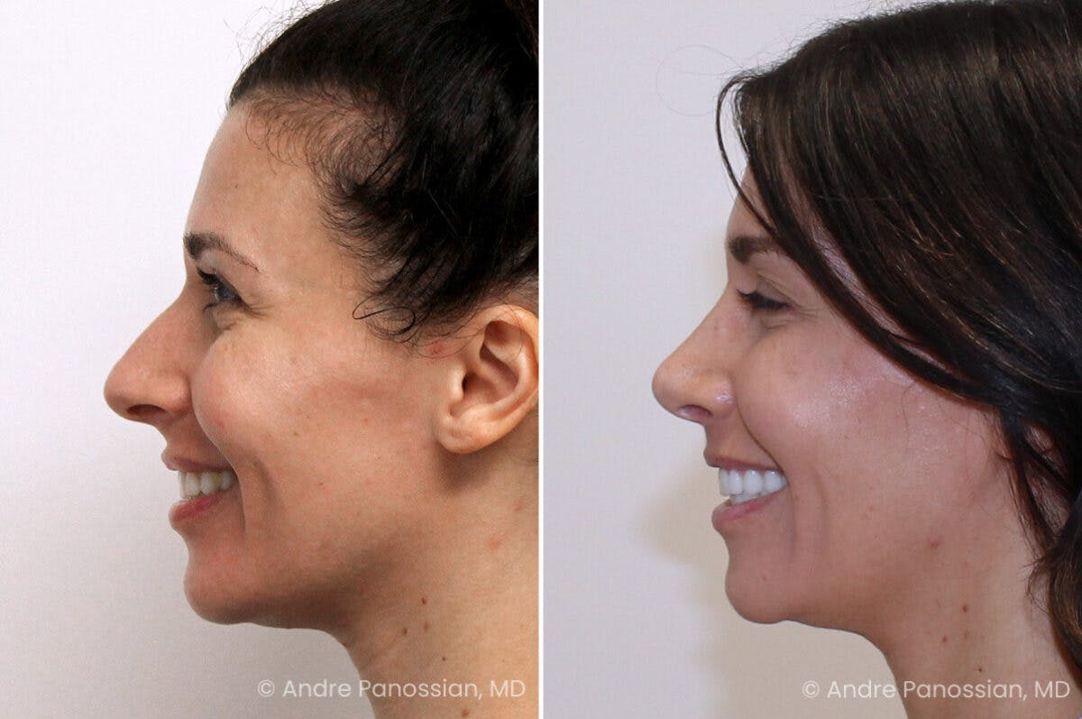 Rhinoplasty Before & After Gallery - Patient 122055 - Image 7