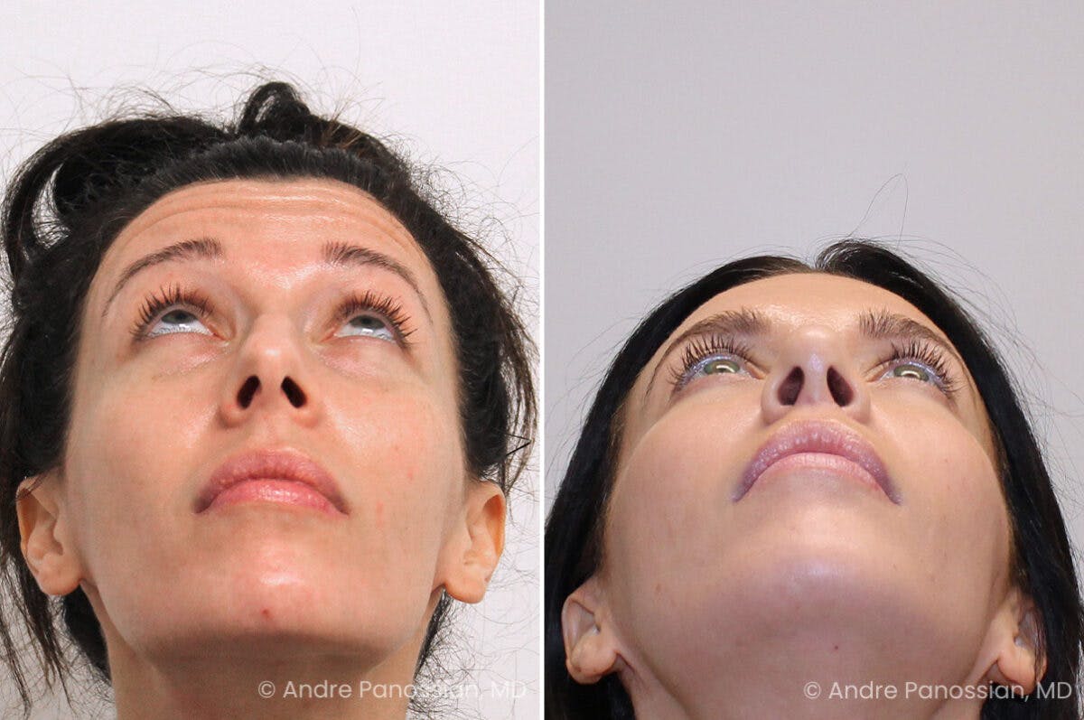 Rhinoplasty Before & After Gallery - Patient 122055 - Image 8