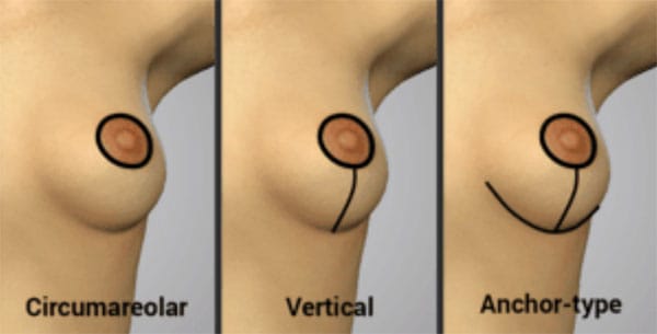 breast lift incision types