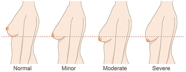 breast drooping infographic