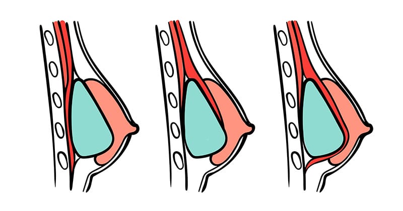 breast implant placement infographic