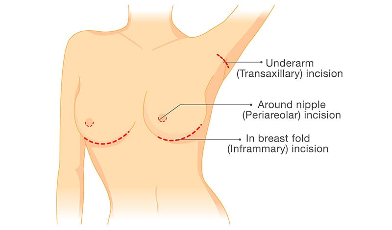 breast augmentation infographic