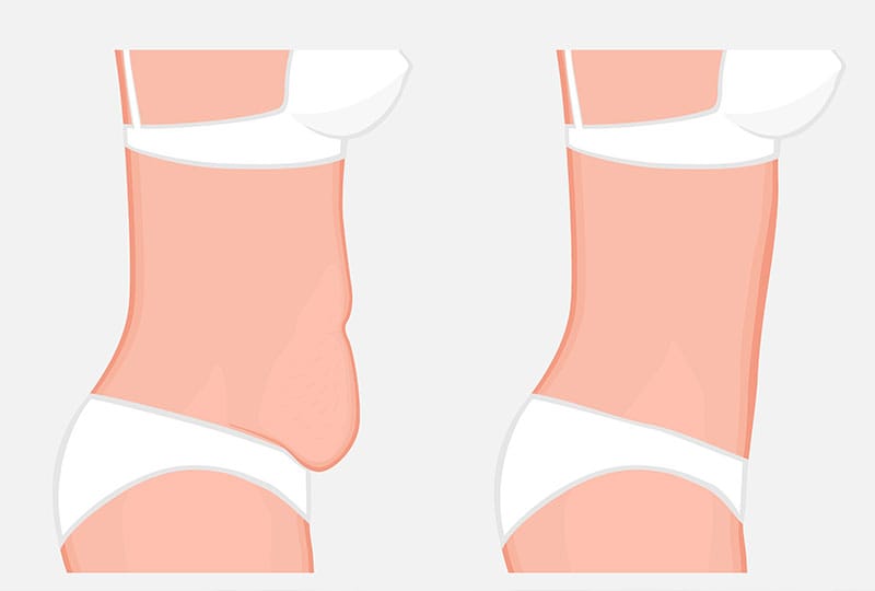 abdominoplasty illustration