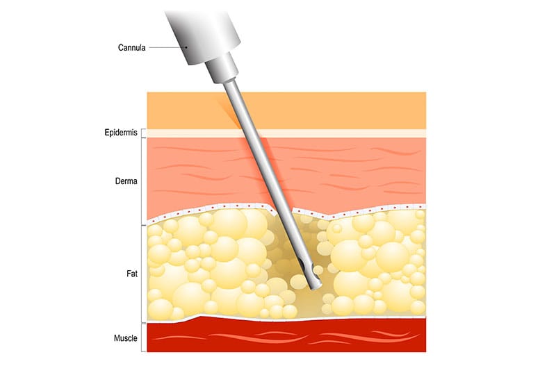 liposuction illustration
