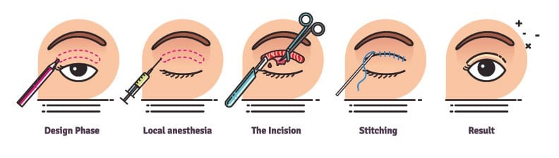 eyelid surgery infographic