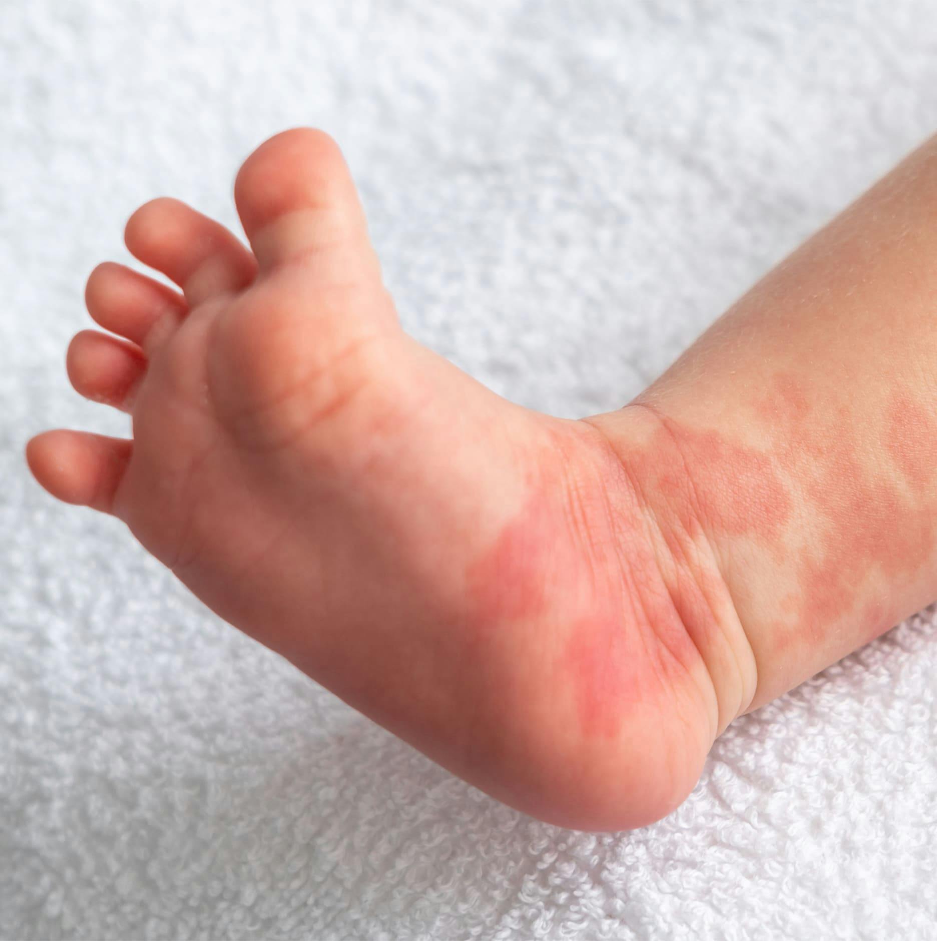 baby's foot with hemangioma on it's ankle