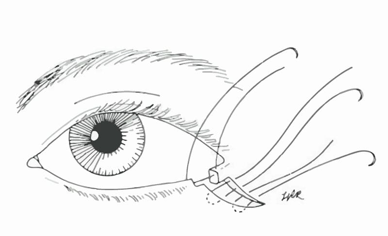 eyelid surgery for facial paralysis