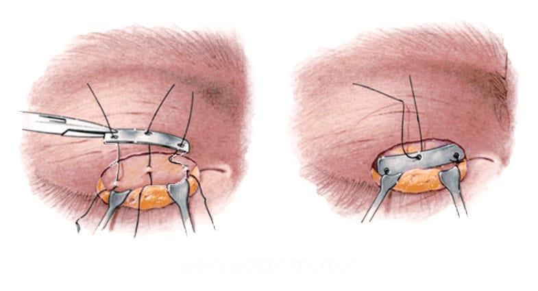 eyelid surgery for facial paralysis