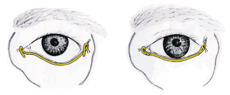 eyelid surgery for facial paralysis