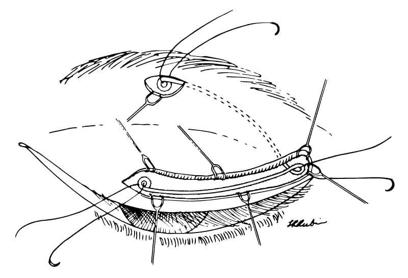 eyelid surgery for facial paralysis