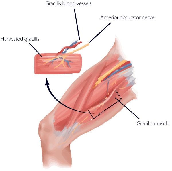 Gracilis Muscle Transplant infographic