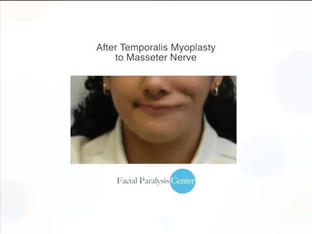 gracilis muscle transplant image