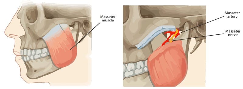 Gracilis Muscle Transplant To Masseter Nerve infographic