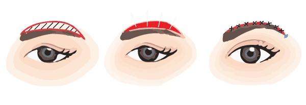 brow lift infographic