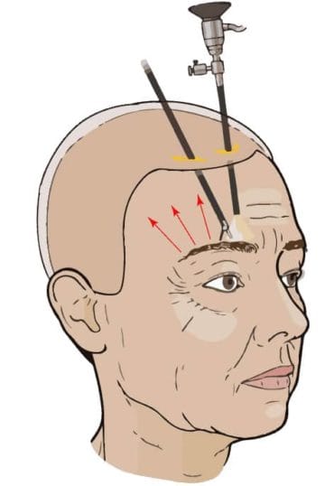 brow lift surgery illustration
